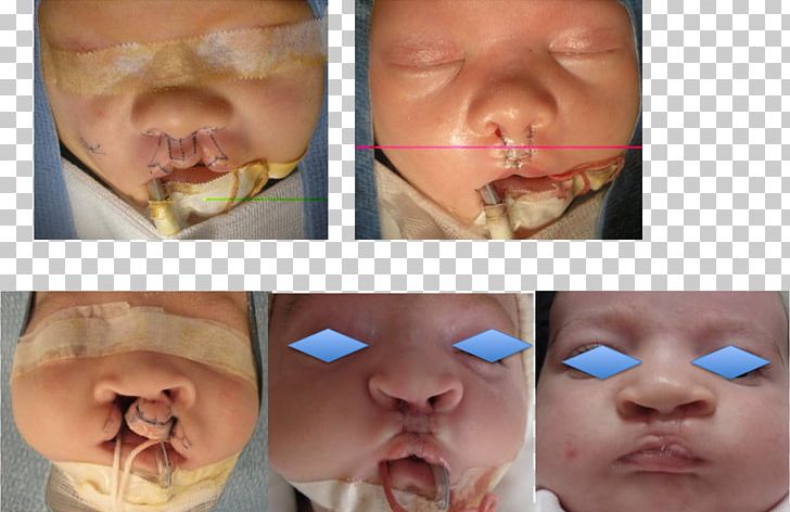 Cleft Lip And Cleft Palate Snout Infant Surgery PNG, Clipart, Cheek, Chin, Cleft Lip And Cleft Palate, Closeup, Ear Free PNG Download