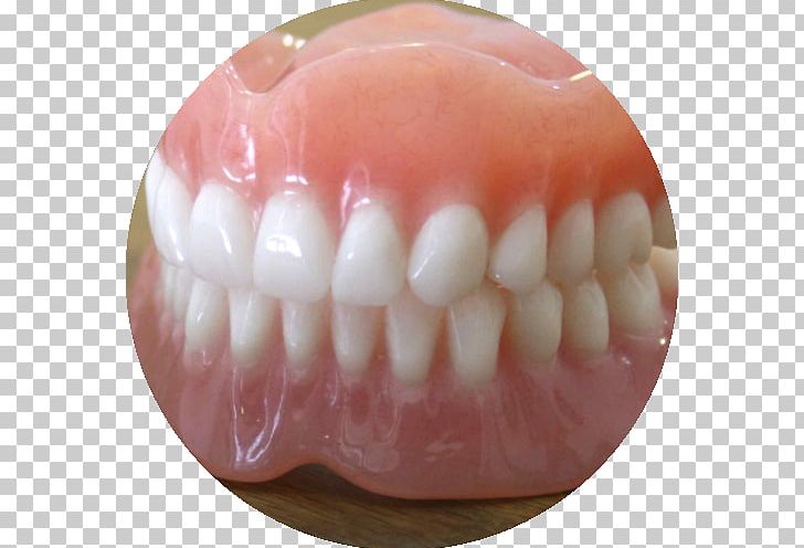 Dentures Prosthesis Dentistry Dental Implant Tooth PNG, Clipart, Crown, Dental Extraction, Dental Implant, Dentistry, Dentures Free PNG Download