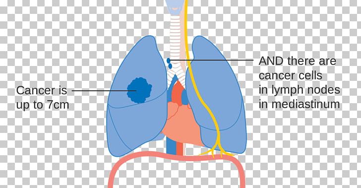 Lung Cancer Staging PNG, Clipart, Angle, Cancer, Cancer Cell, Cancer Research Uk, Cancer Staging Free PNG Download