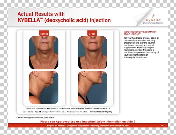 Surgery Deoxycholic Acid Dermatology Chin Submental Triangle PNG, Clipart, Abdomen, Acne, Active Undergarment, Advertising, Arm Free PNG Download