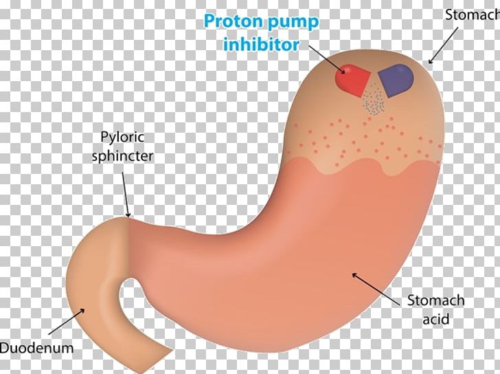 Proton-pump Inhibitor Proton Pump Gastric Acid Enzyme Inhibitor Esomeprazole PNG, Clipart, Abdomen, Angle, Antacid, Arm, Burning Chest Pain Free PNG Download