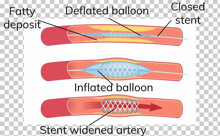 Angioplasty Heart Arteriosclerosis Artery Stenting PNG, Clipart, Angioplasty, Arteriosclerosis, Artery, Atheroma, Blood Vessel Free PNG Download