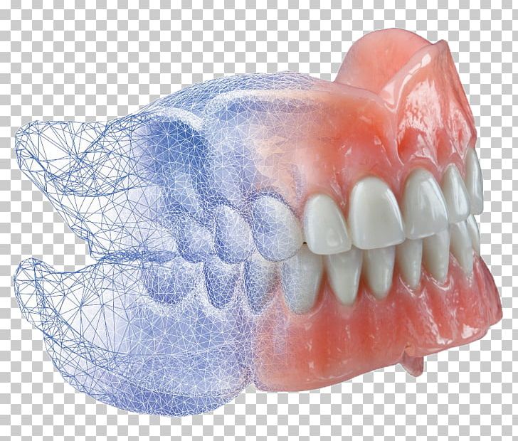 AvaDent Dentures CAD/CAM Dentistry PNG, Clipart, Avadent, Burdette Dental Lab, Cadcam Dentistry, Cosmetic Dentistry, Crowns Free PNG Download