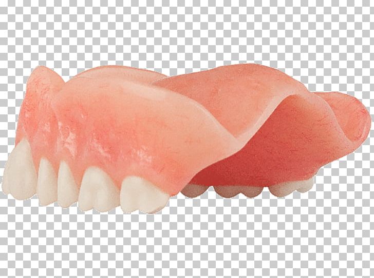 Tooth Dentures Dentistry All-on-4 Dental Implant PNG, Clipart, Ache, Allon4, Arrow, Aspen Dental, Color Free PNG Download