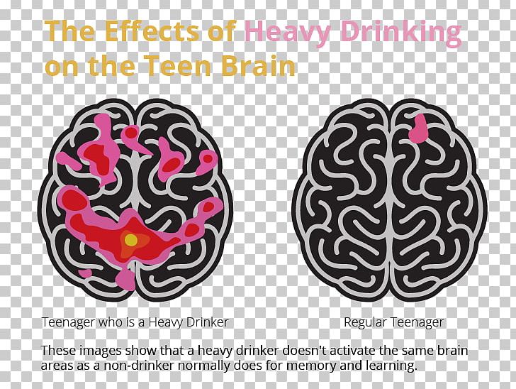 Brain Alcoholism Alcoholic Drink Alcohol And Health Binge Drinking PNG, Clipart,  Free PNG Download