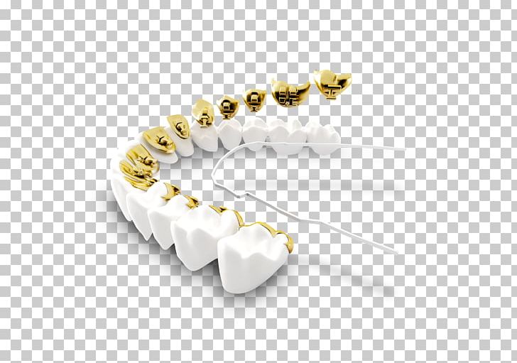 Fusion Orthodontics & Children's Dentistry Clear Aligners Dental Braces Lingual Braces PNG, Clipart, Braces, Clear Aligners, Clearcorrect, Dental Braces, Dental Implant Free PNG Download