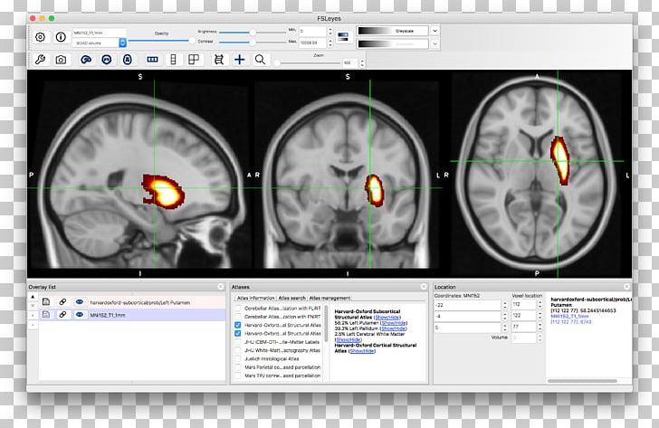 Brain Computed Tomography Neuroimaging PNG, Clipart, Anatomy, Appendix, Atlas, Brain, Computed Tomography Free PNG Download