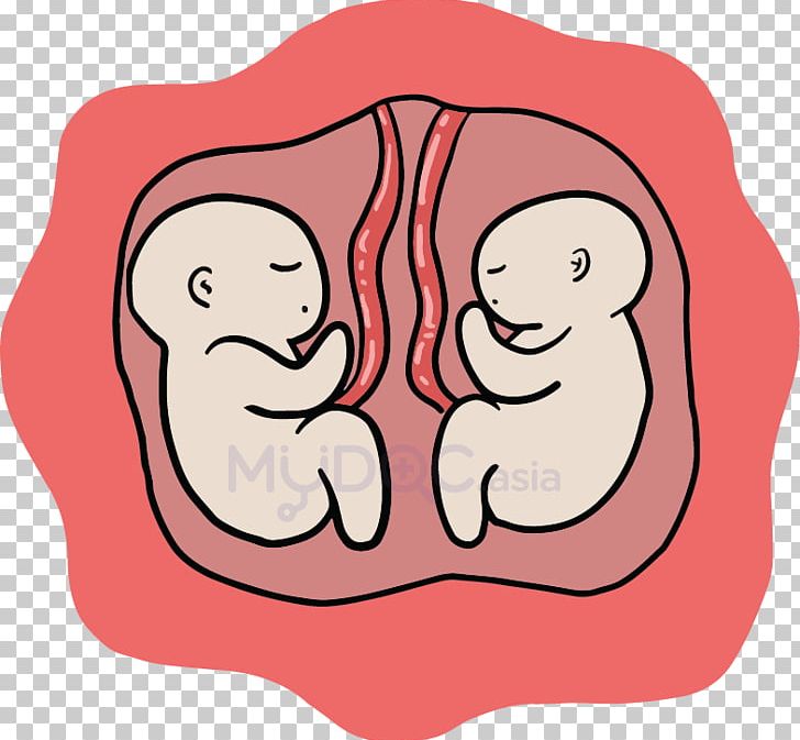 Caesarean Section Birth Mother Twin Pregnancy PNG, Clipart, Art, Baby, Birth, Cartoon, Child Free PNG Download