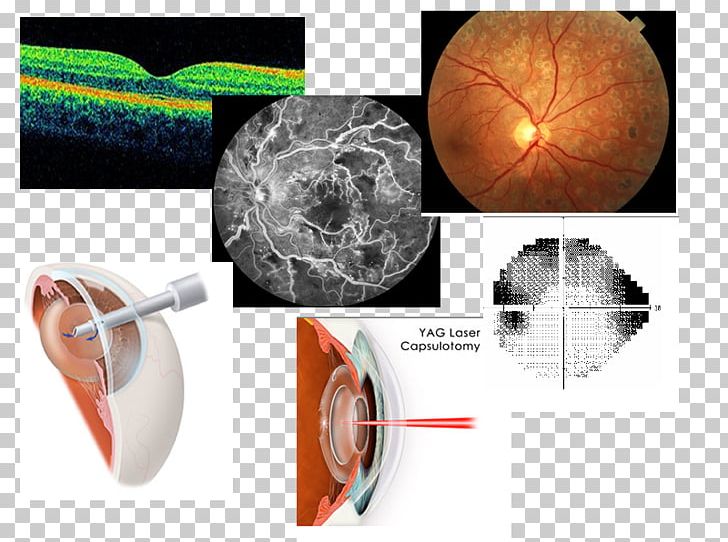 Plastic Cataract Surgery PNG, Clipart, Agerelated Eye Disease Study, Art, Cataract, Cataract Surgery, Plastic Free PNG Download