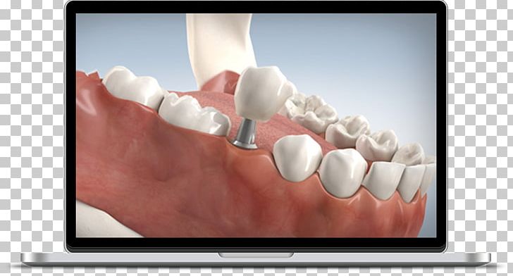 Dental Implant Dentistry Tooth Dentures PNG, Clipart, Bridge, Dental Implant, Dental Laboratory, Dentist, Dentistry Free PNG Download