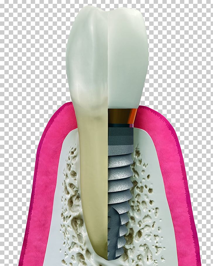 Dental Implant Dentistry Surgery PNG, Clipart, Bridge, Crown, Dental, Dental Extraction, Dental Implant Free PNG Download