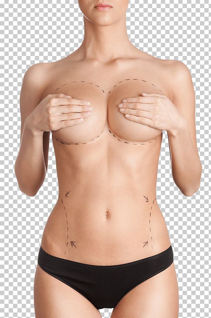 Breast Augmentation Breast Implant Plastic Surgery PNG, Clipart, Abdomen, Abdominoplasty, Active Undergarment, Body Contouring, Brassiere Free PNG Download