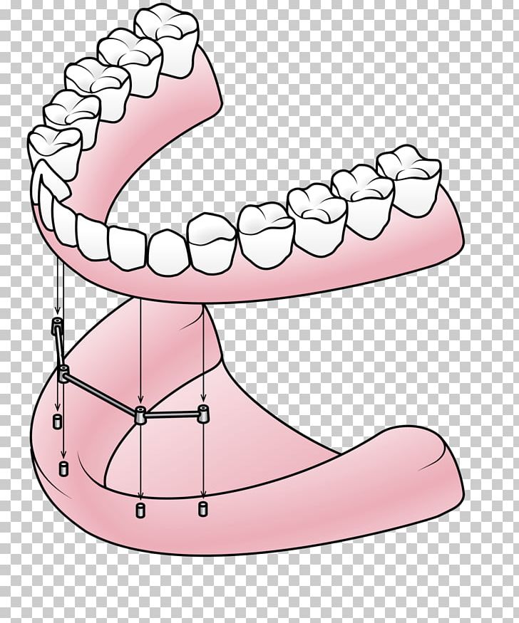 Dental Implant Dentures Dentistry All-on-4 PNG, Clipart, Abutment, Allon4, Bridge, Dental Implant, Dentist Free PNG Download