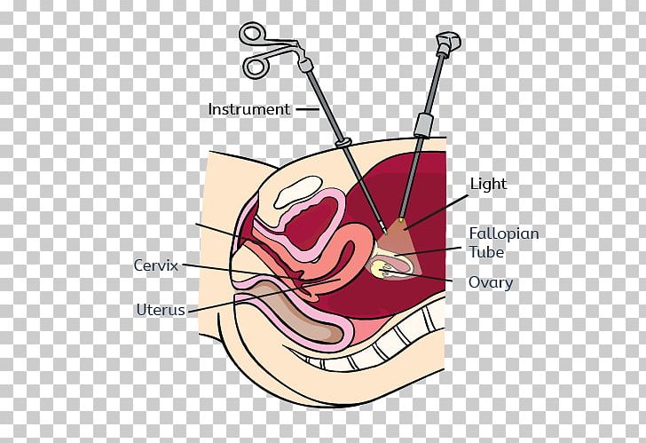 Uterine Fibroid Laparoscopy Uterine Myomectomy Endometriosis Laparotomy PNG, Clipart, Angle, Arm, Cartoon, Cervix, Diagram Free PNG Download