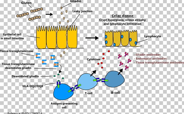 Celiac Disease Autoimmunity Autoimmune Disease Autoantibody PNG, Clipart, Angle, Antibody, Area, Autoimmune Disease, Celiac Disease Free PNG Download