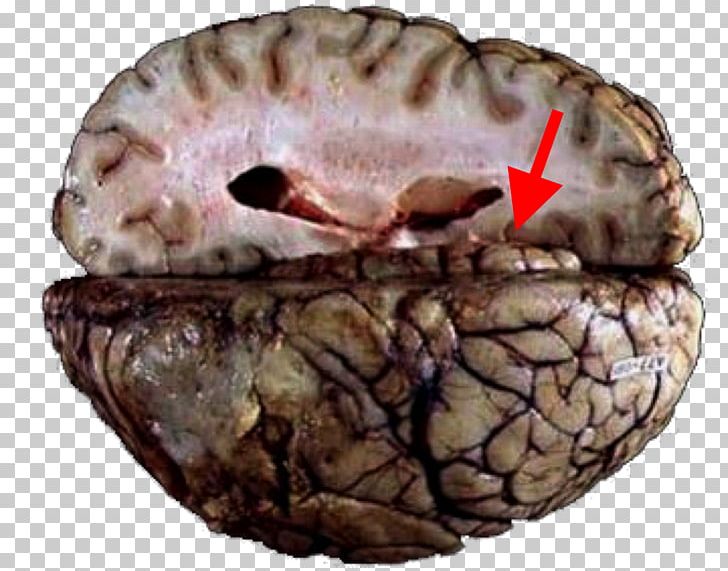 Brain Herniation Cerebellar Tentorium Tentorial Incisure Uncus Cingulate Gyrus PNG, Clipart,  Free PNG Download