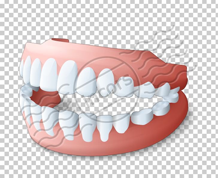 Toothbrush Dentures Dentistry Removable Partial Denture PNG, Clipart, Dental Implant, Dental Restoration, Dentistry, Denture, Dentures Free PNG Download