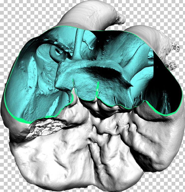 Dentistry Computed Tomography Dental Impression PNG, Clipart, Brain, Bridge, Computed Tomography, Cosmetic Dentistry, Crown Free PNG Download