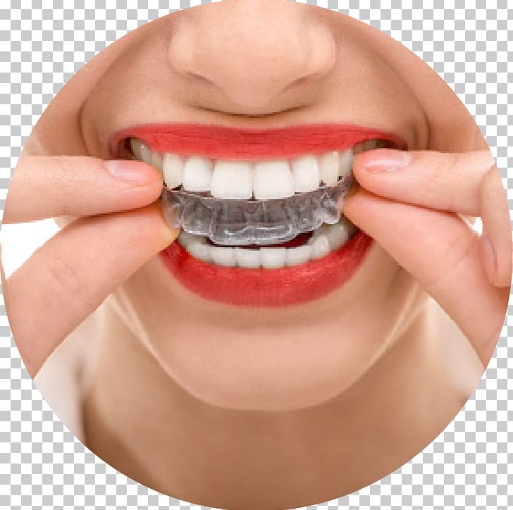 Orthodontics Dentistry Dental Braces Clear Aligners PNG, Clipart, Chin, Cosmetic Dentistry, Crooked Teeth, Dentist, Gnathology Free PNG Download