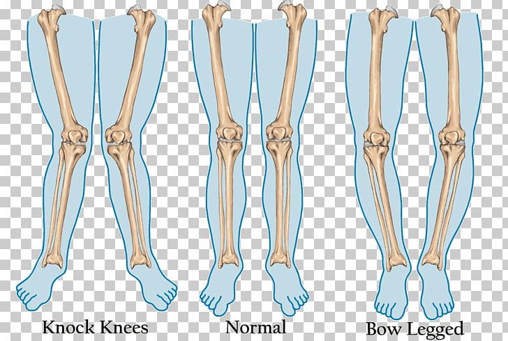 Genu Valgum Genu Varum Human Leg Knee Foot PNG, Clipart, Ankle, Arm, Bone, Child, Deformity Free PNG Download