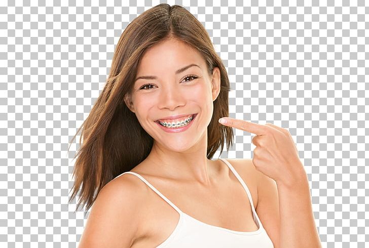 Dental Braces Dentistry Clear Aligners Orthodontics PNG, Clipart, Arm, Beauty, Brown Hair, Cheek, Chin Free PNG Download