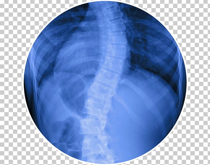 Scoliosis Vertebral Column Surgery Therapy Back Pain PNG, Clipart, Back Brace, Back Pain, Blue, Cobalt Blue, Degenerate Free PNG Download
