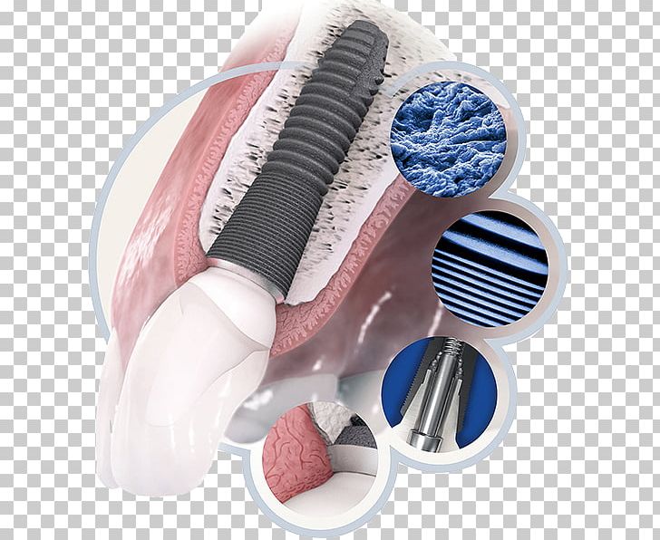 Dental Implant Dentistry Tooth PNG, Clipart, Astra, Bone, Brush, Dental Hygienist, Dental Implant Free PNG Download