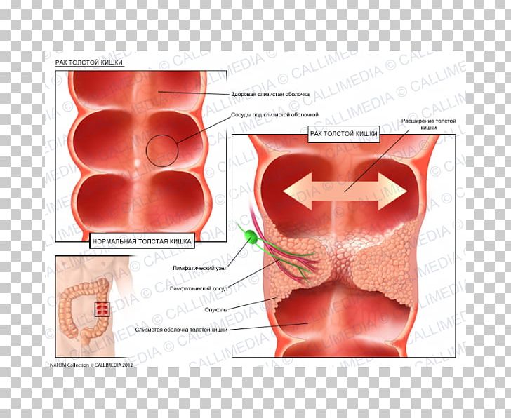 Illustration Anatomique Ductal Carcinoma In Situ Oncology PNG, Clipart, Banco De Imagens, Breast Cancer, Ductal Carcinoma In Situ, Hematology, Illustration Anatomique Free PNG Download