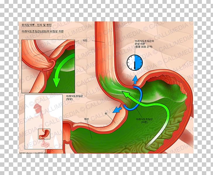 Esophagus Sphincter Cardia Sfintere Esofageo Inferiore Gastroesophageal Reflux Disease PNG, Clipart,  Free PNG Download