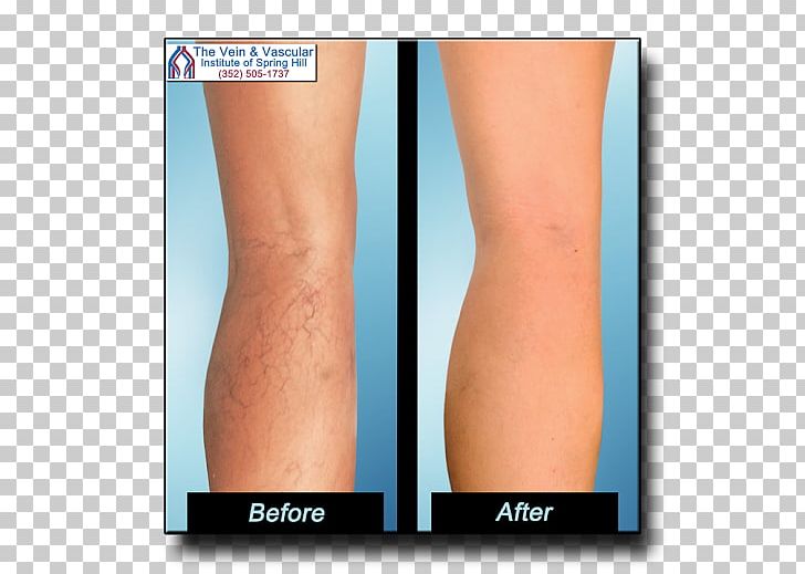 Varicose Veins Endovenous Laser Treatment Telangiectasia Therapy PNG, Clipart, Abdomen, Arm, Calf, Cardiovascular Disease, Chin Free PNG Download
