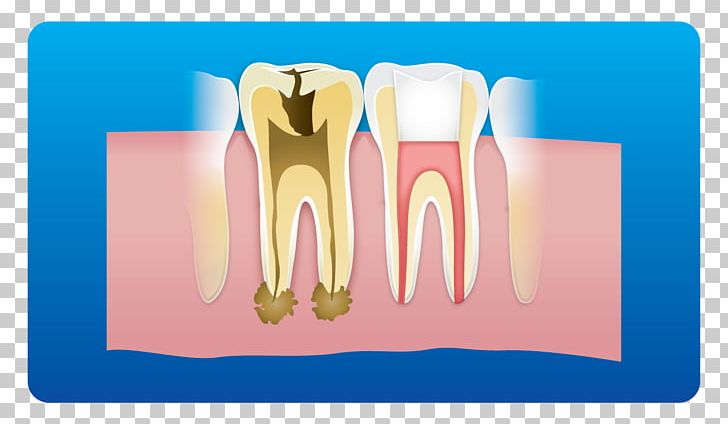 Tooth Dental Implant Root Canal Dentistry Pulp PNG, Clipart, Card, Care, Dental, Dental Braces, Dental Care Free PNG Download
