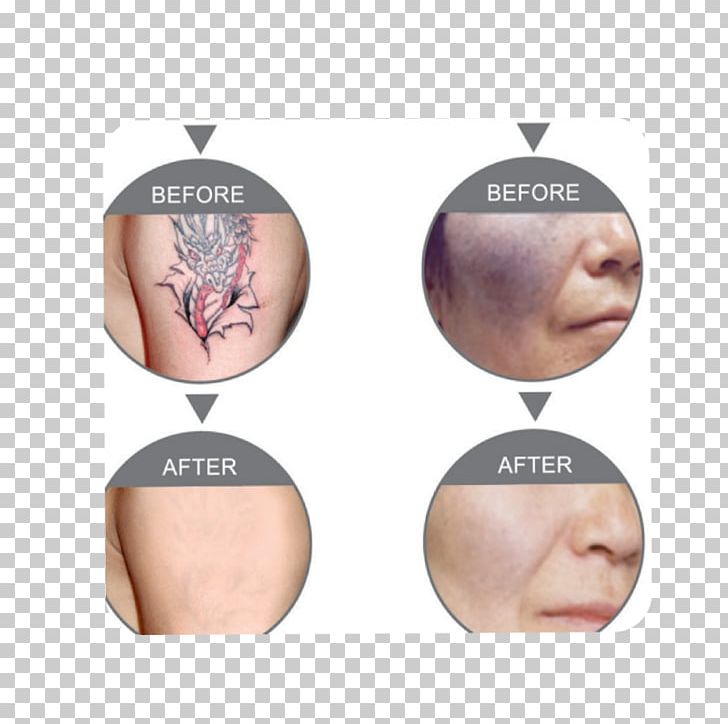 Nd:YAG Laser Tattoo Removal Photorejuvenation Laser Hair Removal PNG, Clipart, Cheek, Chin, Clinic, Ear, Facial Rejuvenation Free PNG Download