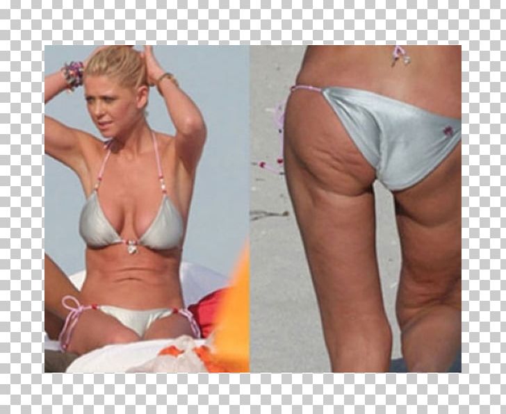 Cellulite Denise Bidot Stretch Marks Buttocks Model PNG, Clipart, Abdomen, Active Undergarment, Briefs, Buttocks, Celebrity Free PNG Download