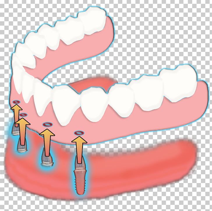 Tooth Mini Dental Implants: Principles And Practice Complete Dentures PNG, Clipart, Bridge, Complete Dentures, Dental Implant, Dentistry, Dentures Free PNG Download