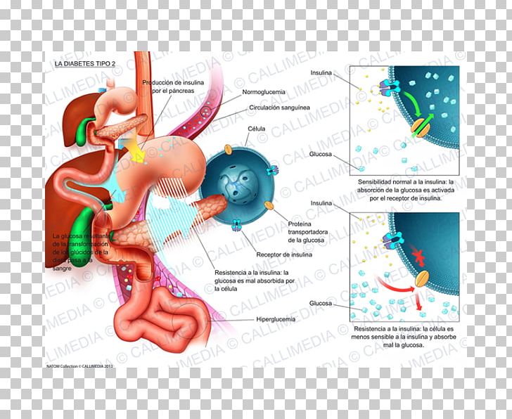 Diabetes Mellitus Type 2 Illustration Internal Medicine Niimi Clinic PNG, Clipart, Area, Banco De Imagens, Blood Glucose Meters, Blood Sugar, Diabetes Mellitus Free PNG Download