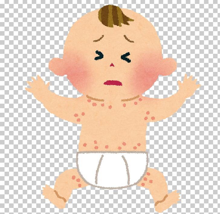 Food Allergy 離乳食 Infant PNG, Clipart, Allergy, Anaphylaxis, Art, Atopic Dermatitis, Boy Free PNG Download