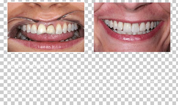 Dentures Close-up Human Tooth PNG, Clipart, Bleaching, Cheek, Chin, Closeup, Closeup Free PNG Download