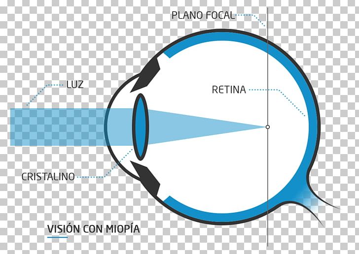 Presbyopia Floater Eye Far-sightedness Near-sightedness PNG, Clipart, Astigmatism, Blue, Blurred Vision, Brand, Circle Free PNG Download