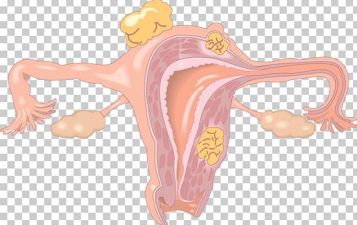 Ovary Uterine Fibroid Uterus Hormone Replacement Therapy Gynaecology PNG, Clipart, Cervix, Disease, Ear, Finger, Gynaecology Free PNG Download