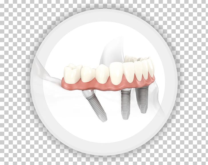All-on-4 Dental Implant Dentistry Edentulism PNG, Clipart, Allon4, Bridge, Dds, Dental, Dental Implant Free PNG Download