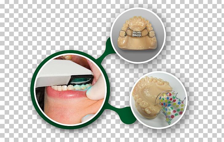 Retainer Orthodontics Laboratory Dental Braces Orthodontic Technology PNG, Clipart, Appliances, Business, Dental Laboratory, Dentistry, Digital Free PNG Download