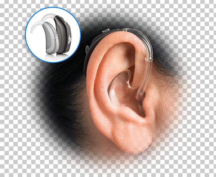 Hearing Aid Earmold Audiology PNG, Clipart, Aids, Audiology, Behind, Boneanchored Hearing Aid, Chin Free PNG Download