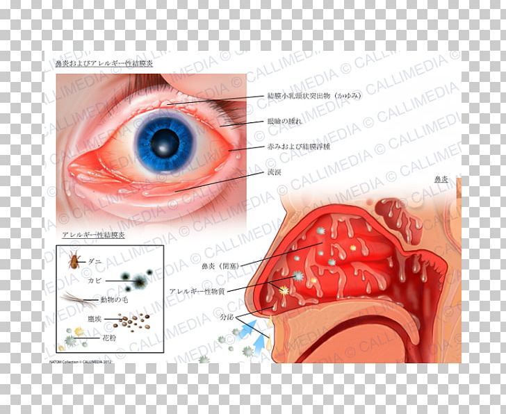 Allergic Conjunctivitis Hay Fever Rhinitis Allergy PNG, Clipart, Allergic Conjunctivitis, Allergy, Chronic Condition, Common Cold, Conjunctiva Free PNG Download