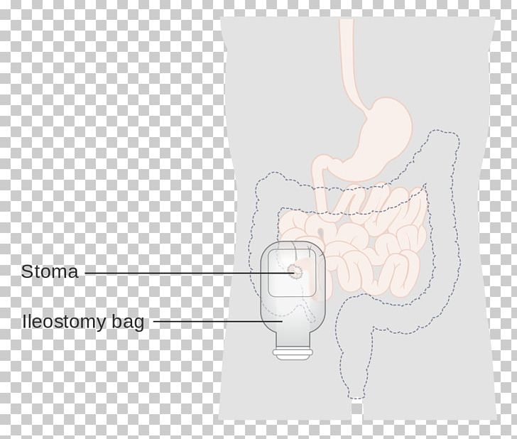 Ileostomy Abdomen Hip Shoulder Thumb PNG, Clipart, Abdomen, Bag, Cancer Research Uk, Diagram, Ear Free PNG Download