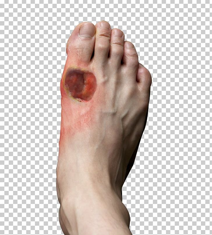 Diabetic Foot Ulcer Diabetes Mellitus Athlete's Foot PNG, Clipart, Ankle, Athletes Foot, Bunion, Diabetes Mellitus, Diabetic Foot Free PNG Download