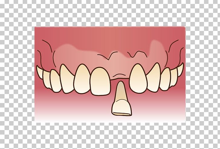 審美歯科 Dentist Dentures Dental Technician PNG, Clipart, Bridge, Dental Braces, Dental Implant, Dental Technician, Dentist Free PNG Download