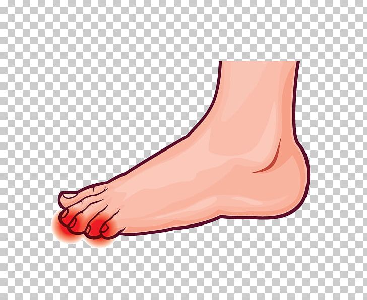 Thumb Toe Ankle Pronation Of The Foot PNG, Clipart, Achilles Tendinitis, Ankle, Arm, Ball, Bunion Free PNG Download