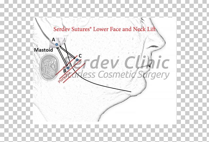 Serdev Suture Surgical Suture Surgery Rhytidectomy Superficial Muscular Aponeurotic System PNG, Clipart, Angle, Area, Cosmetics, Diagram, Ear Free PNG Download