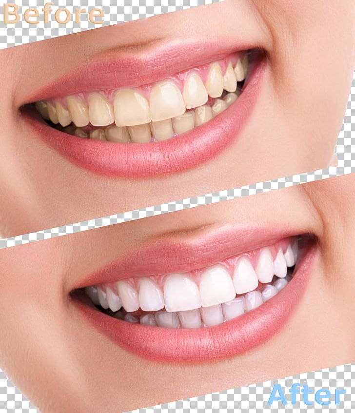 Tooth Whitening Human Tooth Cosmetic Dentistry PNG, Clipart, Baby Teeth, Chart, Cheek, Chin, Clean Free PNG Download