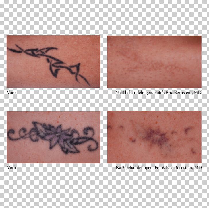 Laser Pico Tattoo Therapy Skin PNG, Clipart, Color, Dalton, Flesh, Innovation, Laser Free PNG Download
